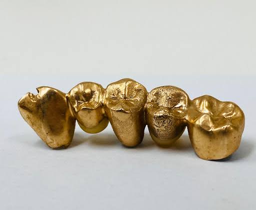 金歯の純度について【大阪で金買取、高く売るならゴールドウィン 梅田  